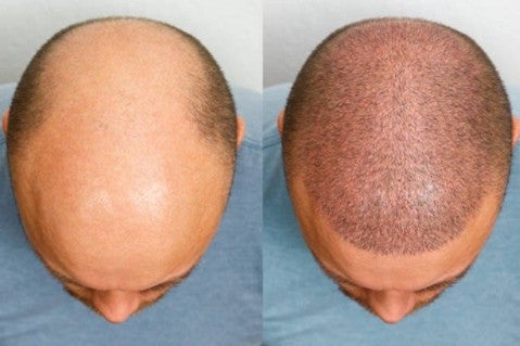 We do Hair Transplant and Hair Restoration Services in Harrisburg PA